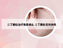 二丁颗粒治疗银屑病么 二丁颗粒见效快吗