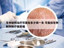 生物制剂治疗可善挺多少钱一支 可善挺生物制剂制疗银屑病