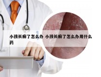 小孩长癣了怎么办 小孩长癣了怎么办用什么药