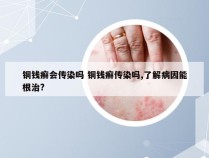 铜钱癣会传染吗 铜钱癣传染吗,了解病因能根治?