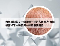 大腿根部长了一块像癣一样的东西图片 大腿根部长了一块像癣一样的东西图片