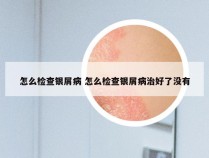 怎么检查银屑病 怎么检查银屑病治好了没有