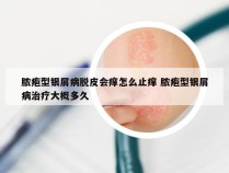 脓疱型银屑病脱皮会痒怎么止痒 脓疱型银屑病治疗大概多久