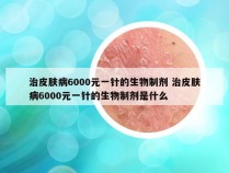 治皮肤病6000元一针的生物制剂 治皮肤病6000元一针的生物制剂是什么