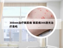 308nm治疗银屑病 银屑病308激光治疗贵吗