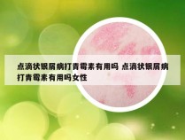 点滴状银屑病打青霉素有用吗 点滴状银屑病打青霉素有用吗女性