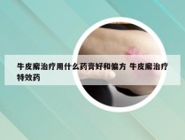 牛皮廨治疗用什么药膏好和偏方 牛皮廨治疗特效药