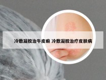 冷敷凝胶治牛皮癣 冷敷凝胶治疗皮肤病