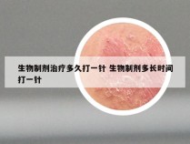 生物制剂治疗多久打一针 生物制剂多长时间打一针