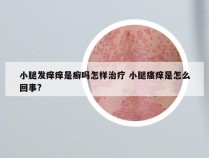 小腿发痒痒是癣吗怎样治疗 小腿瘙痒是怎么回事?