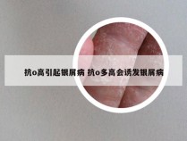 抗o高引起银屑病 抗o多高会诱发银屑病