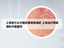 上海有什么中医院看银屑病的 上海治疗银屑病的中医医院