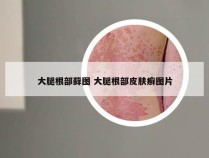 大腿根部藓图 大腿根部皮肤癣图片