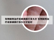 生物制剂治疗皮肤病需打多久针 生物制剂治疗皮肤病需打多久针才能好