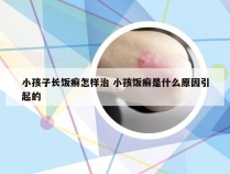 小孩子长饭癣怎样治 小孩饭癣是什么原因引起的