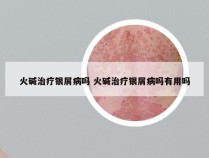 火碱治疗银屑病吗 火碱治疗银屑病吗有用吗