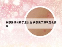 头部受凉长癣了怎么治 头部受了凉气怎么去除