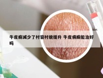 牛皮癣减少了村容村貌提升 牛皮病癣能治好吗