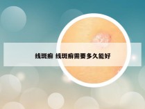 线斑癣 线斑癣需要多久能好