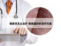 银屑该怎么治疗 银屑最好的治疗方案