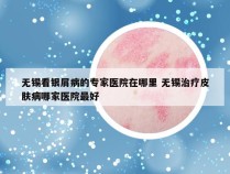 无锡看银屑病的专家医院在哪里 无锡治疗皮肤病哪家医院最好