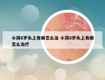 小孩8岁头上有癣怎么治 小孩8岁头上有癣怎么治疗