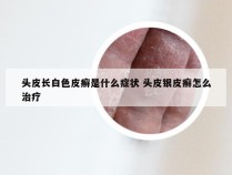 头皮长白色皮癣是什么症状 头皮银皮癣怎么治疗