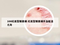 100红皮型银屑病 红皮型银屑病不治能活几年