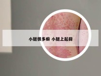 小腿很多癣 小腿上起藓