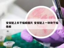 宝宝腿上长干燥癣图片 宝宝腿上一块块干燥像癣