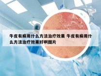 牛皮有癣用什么方法治疗效果 牛皮有癣用什么方法治疗效果好啊图片