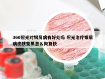 360照光对银屑病有好处吗 照光治疗银屑病皮肤变黑怎么恢复快