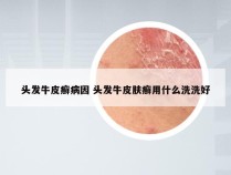 头发牛皮癣病因 头发牛皮肤癣用什么洗洗好