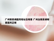 广州银屑病医院地址在哪里 广州治银屑病哪里医院正规