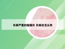 长癣严重的腿图片 长癣会怎么样