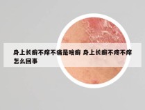 身上长癣不痒不痛是啥癣 身上长癣不疼不痒怎么回事