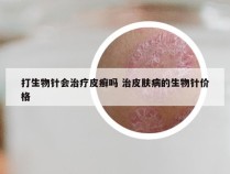 打生物针会治疗皮癣吗 治皮肤病的生物针价格