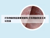 打生物制剂后需要观察吗 打生物制剂多久可以洗澡