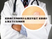 皮肤病打生物制剂什么情况不能打 皮肤病什么情况下打生物制剂