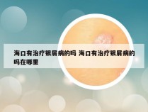 海口有治疗银屑病的吗 海口有治疗银屑病的吗在哪里