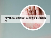 孩子身上起藓是什么引起的 孩子身上起癣图片