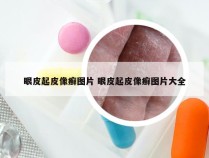 眼皮起皮像癣图片 眼皮起皮像癣图片大全