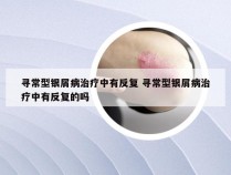 寻常型银屑病治疗中有反复 寻常型银屑病治疗中有反复的吗