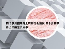 四个多月孩子身上有癣什么情况 四个月孩子身上长癣怎么回事