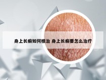 身上长癣如何根治 身上长癣要怎么治疗