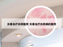 长春治疗白斑医院 长春治疗白斑病的医院