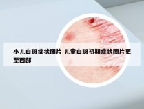 小儿白斑症状图片 儿童白斑初期症状图片更至西部