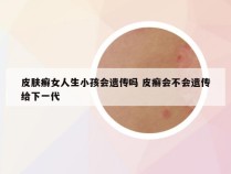 皮肤癣女人生小孩会遗传吗 皮癣会不会遗传给下一代