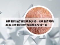 生物制剂治疗皮肤病多少钱一针有副作用吗 2021生物制剂治疗皮肤病多少钱一支