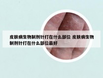 皮肤病生物制剂针打在什么部位 皮肤病生物制剂针打在什么部位最好